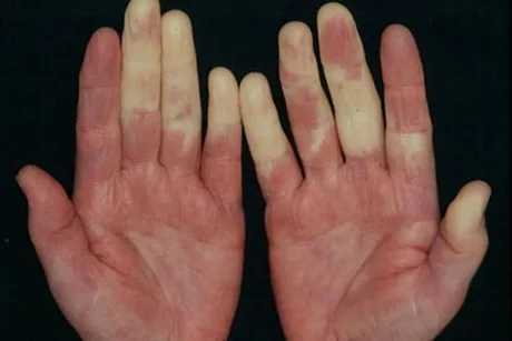 Habrá una campaña para detectar el Fenómeno de Raynaud en los salteños